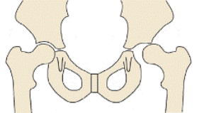 Orthopaedic Dislocated Hip Image